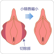 小陰唇縮小
