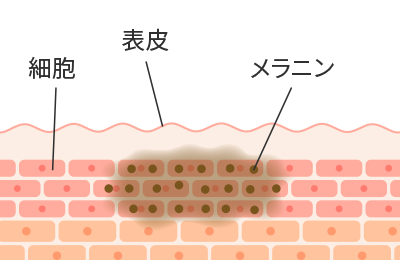 シミ・そばかすができた肌